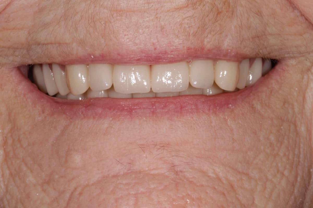 Implant Retained Case 1