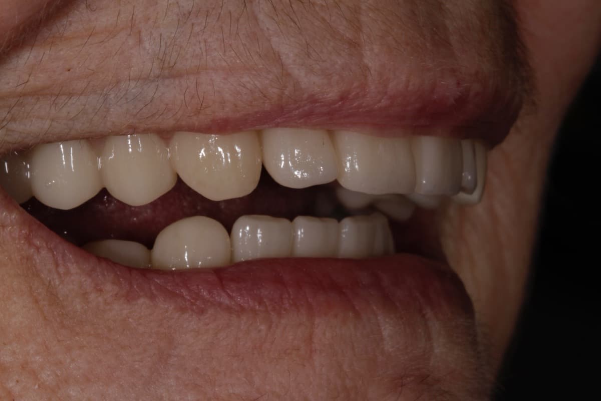 Implant Retained Case 3