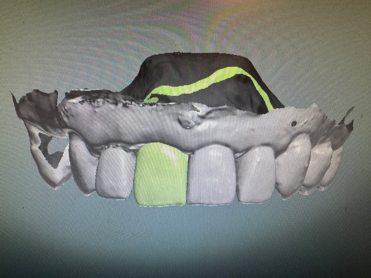 Partial Denture Case 1