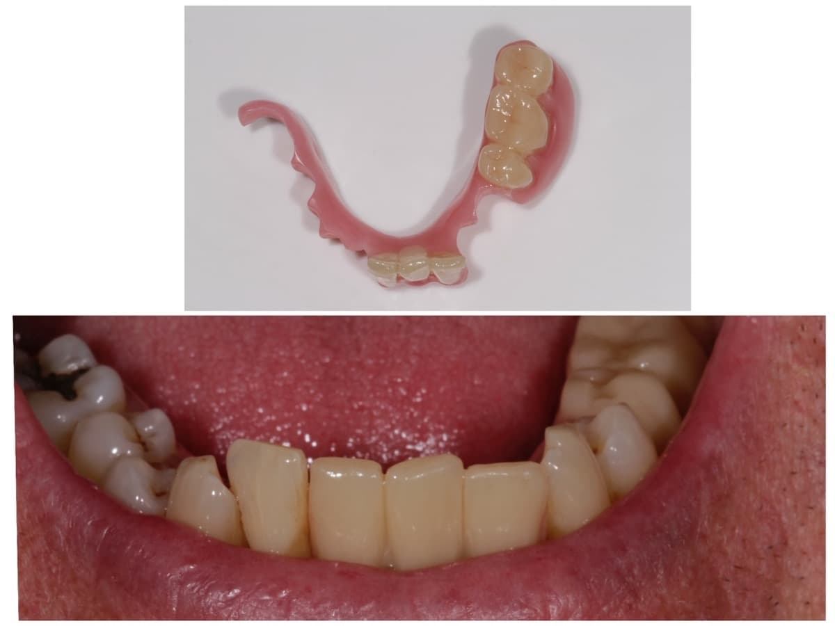 Partial Denture Case 3